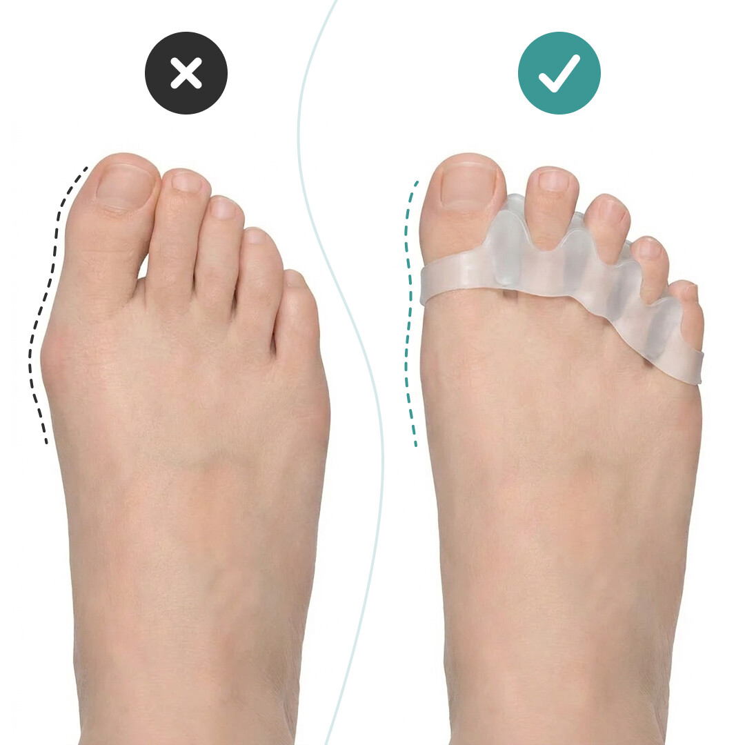 OrthoRelax® – Gél Lábujj Elválasztó (2 elválasztó) - Image 2
