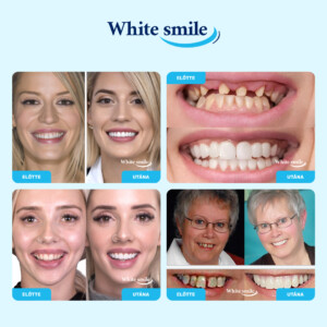Alternative view of WHITESMILE™ – Állítható Kozmetikai Foghéj